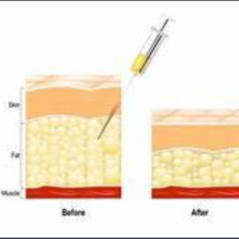 Fat Dissolve Injections at Glo'Up Body Spa in Atlanta, GA