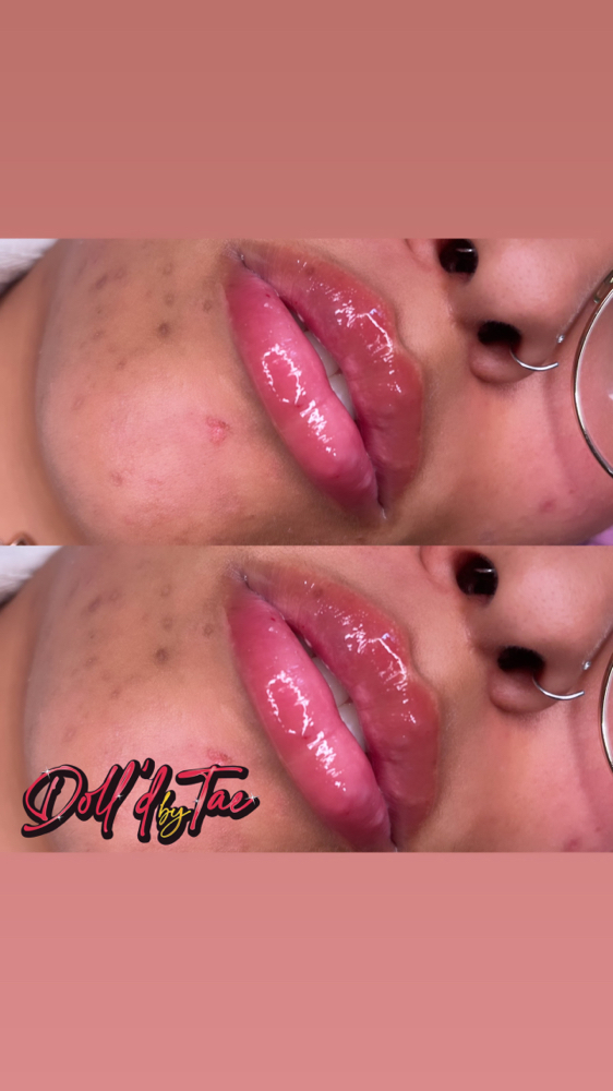 Needle-less Fillers (MODELS ONLY)
