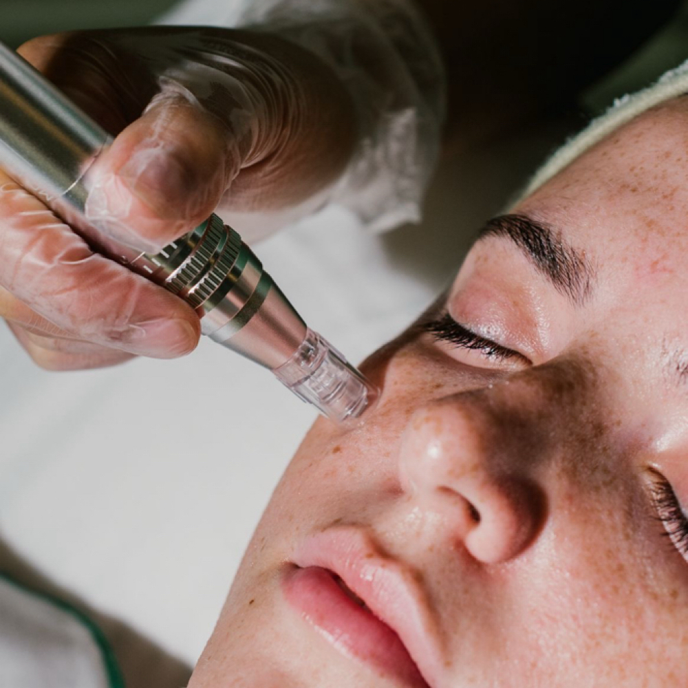 Nano Needling at Esthetics By Bailey in Crossville, TN