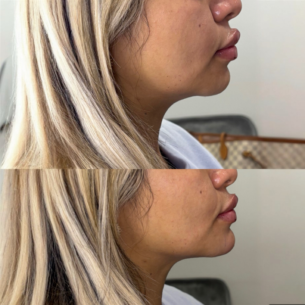 1mL Lip Filler + Chin Filler at The Luxxy Lab in Dallas, TX
