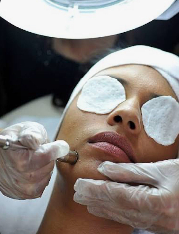 Add-On Microdermabrasion