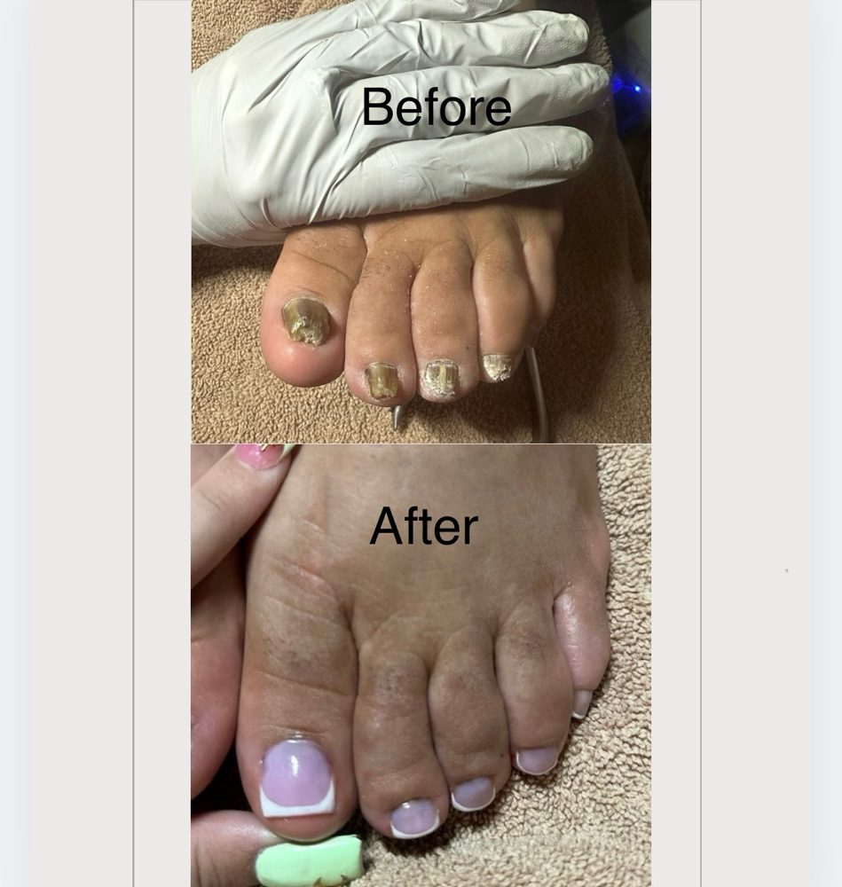Toe BBL (Reconstruction) 100$
