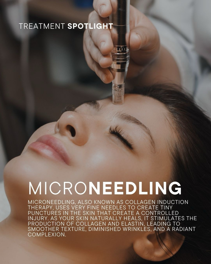 Micro-Needling