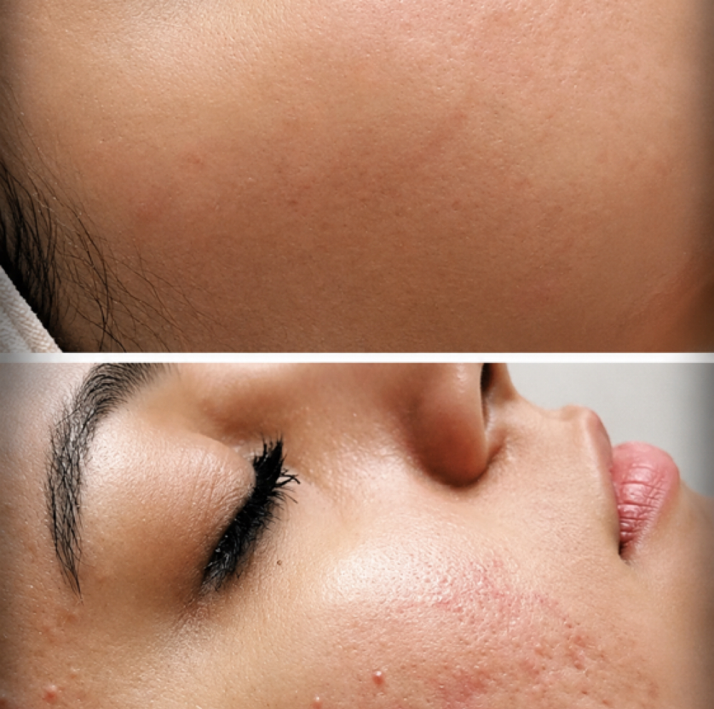 Microchanneling - Acne/Inflamamtion at BE TRU BEAUTY SPA in Fairfield, CT