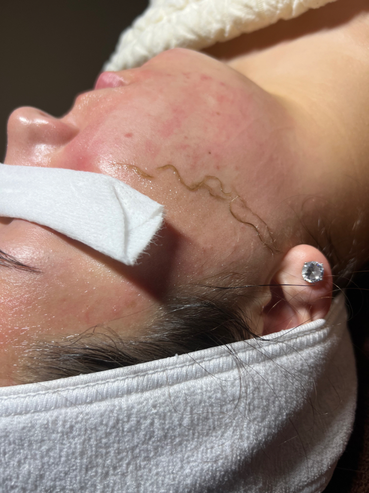 Dermaplaning Facial