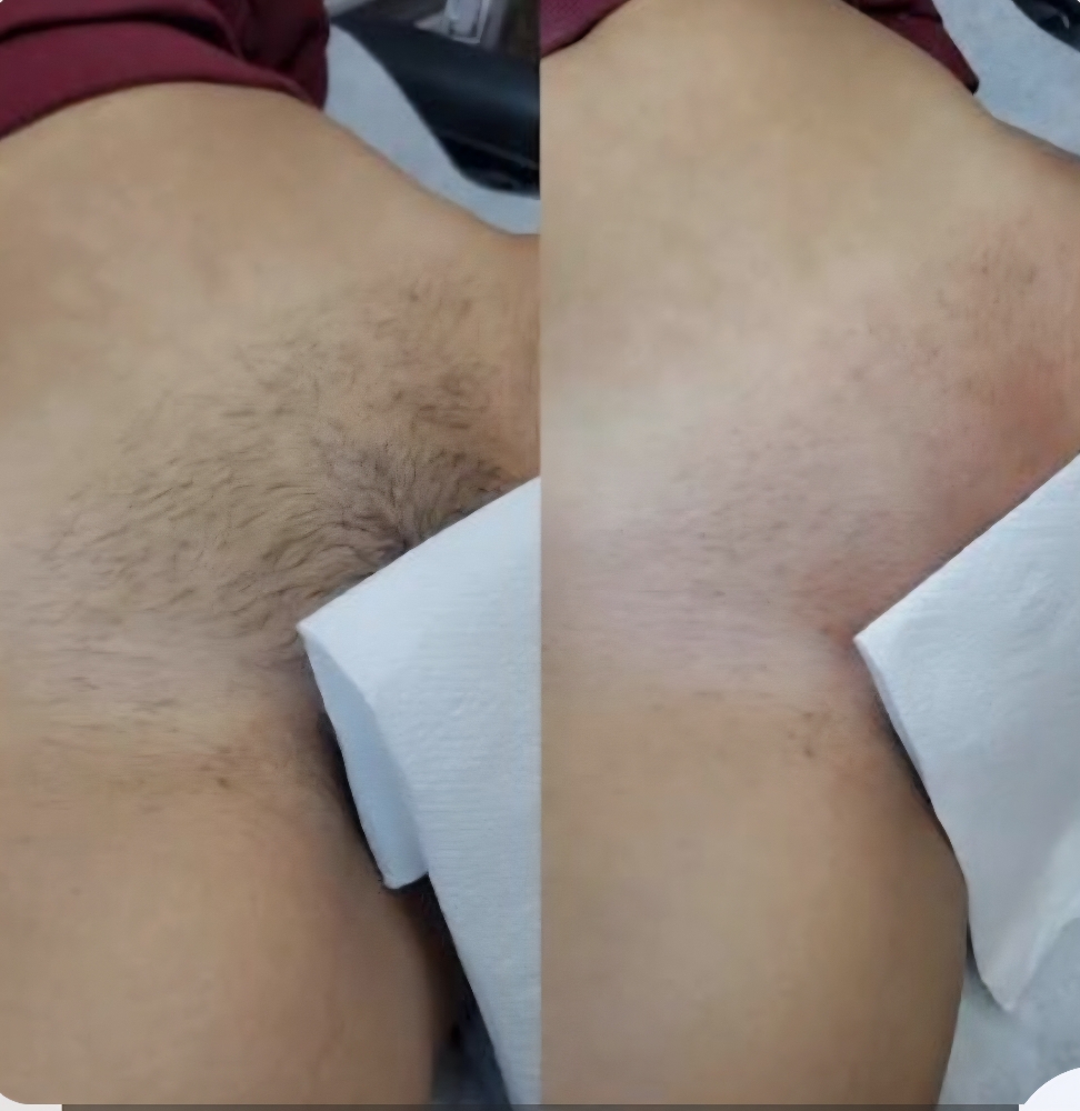 Bikini Wax at Blissfully Radiant Esthetics in Valley-Stream, NY