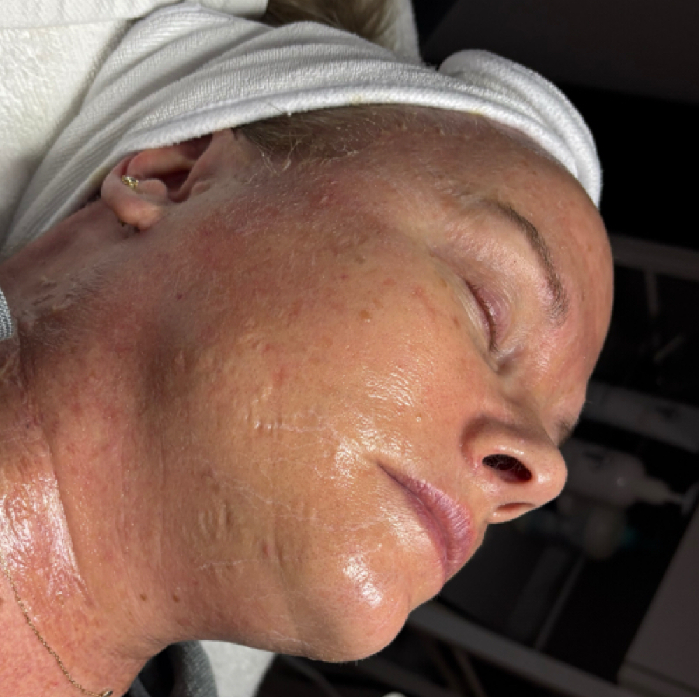 Firming Peptide Treatment at Lindsay Aesthetics in Pontotoc, MS