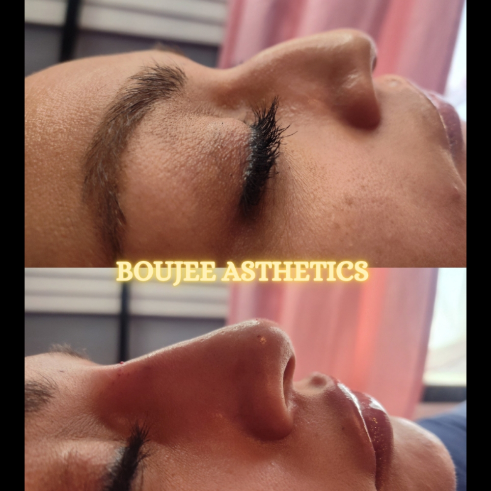 Liquid Nose Job 👃 at Boujee Asthetics ✨ in Tucson, AZ