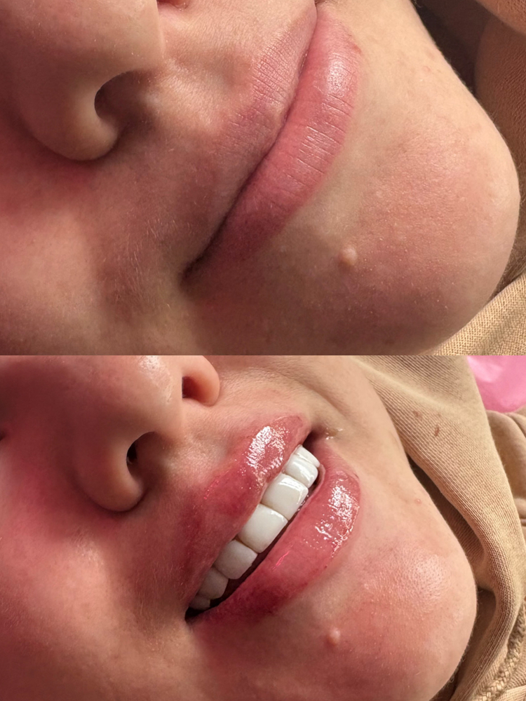 Lip Filler / Relleno De Labios