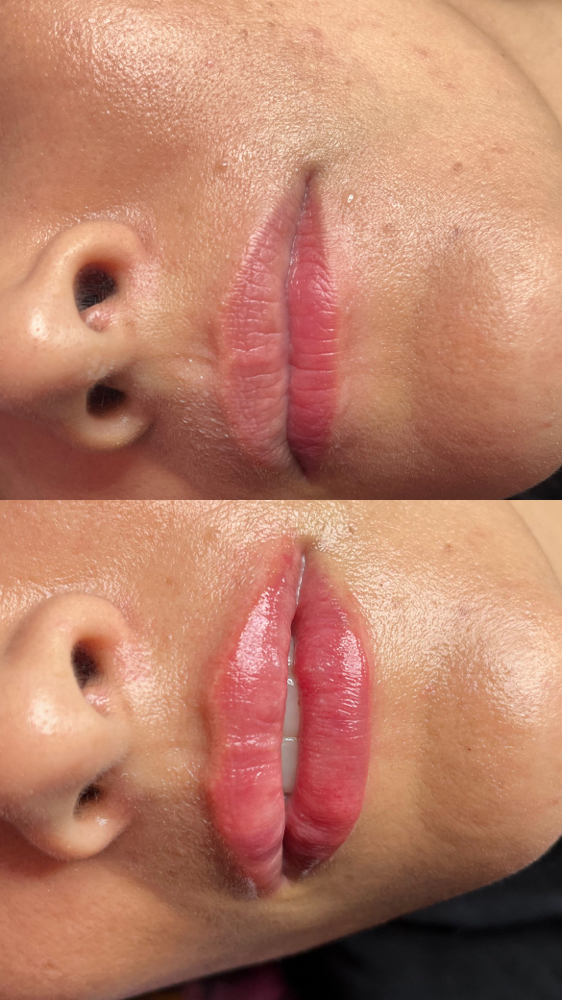 Lip Filler / Relleno De Labios