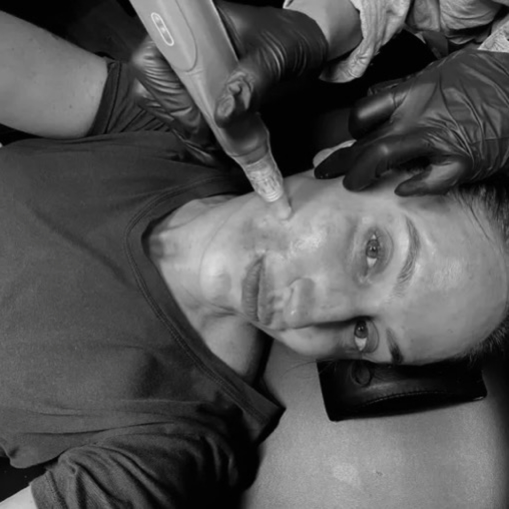 Microneedling (Face) at Skin Society Hawaii in Honolulu, HI