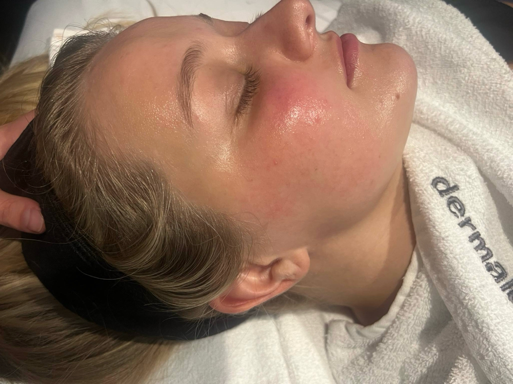 Acne Bootcamp