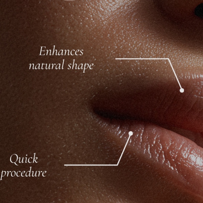 Lip Flip/Elevacion Sutil del Labio at Alma Latina Holistic Beauty in Fort Worth, TX