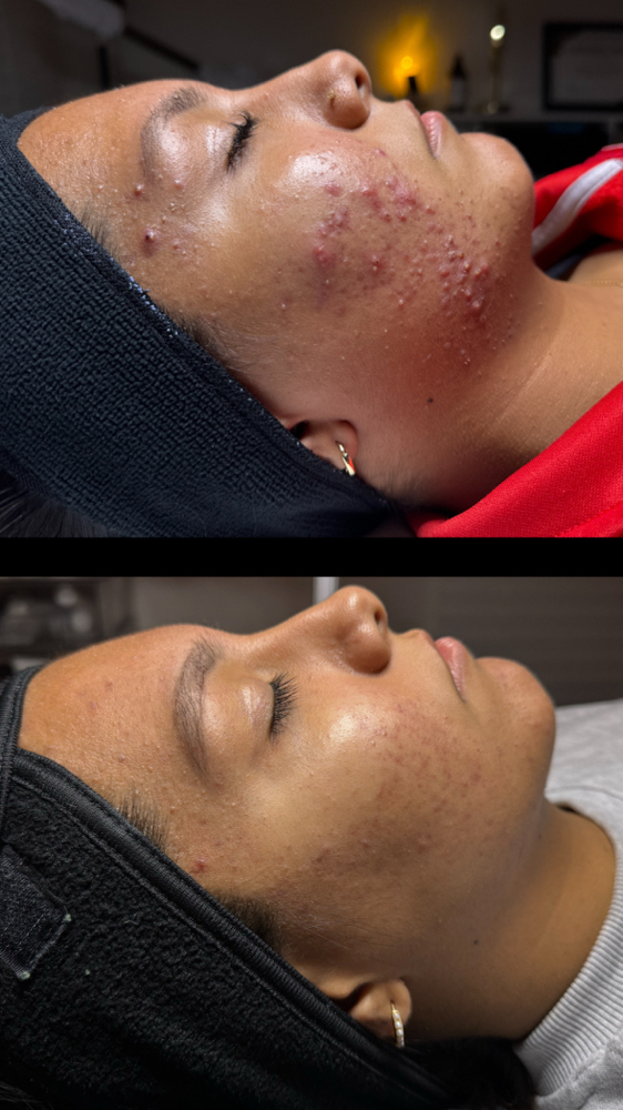 Corrective Facial: 2nd Phase