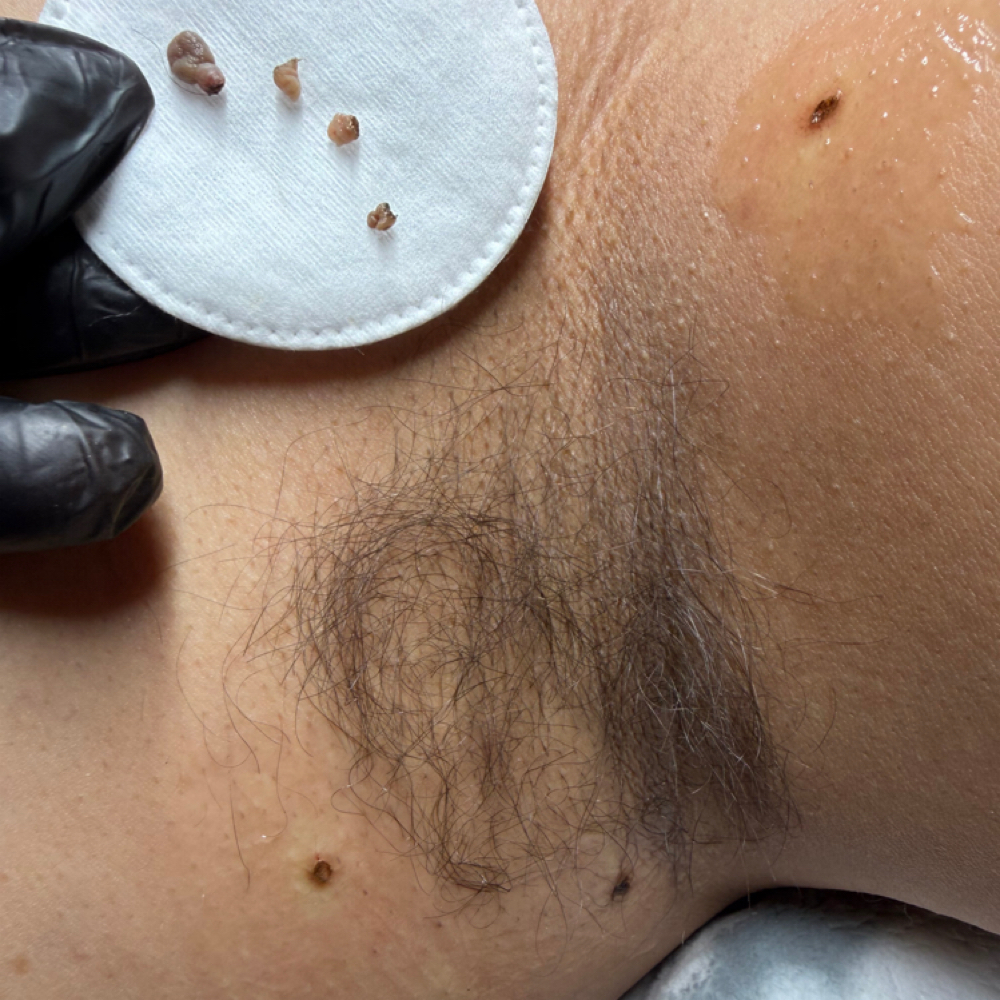 Skin Tag Removal at Attitude Aesthetics in Thornton, CO