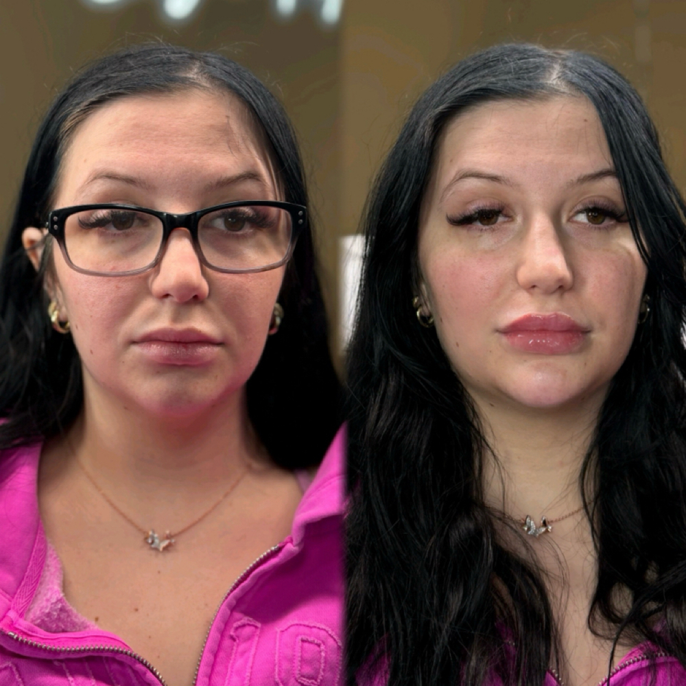 Lip & 1 Facial Area Combo at Eluxy Aesthetics in Arlington, TX