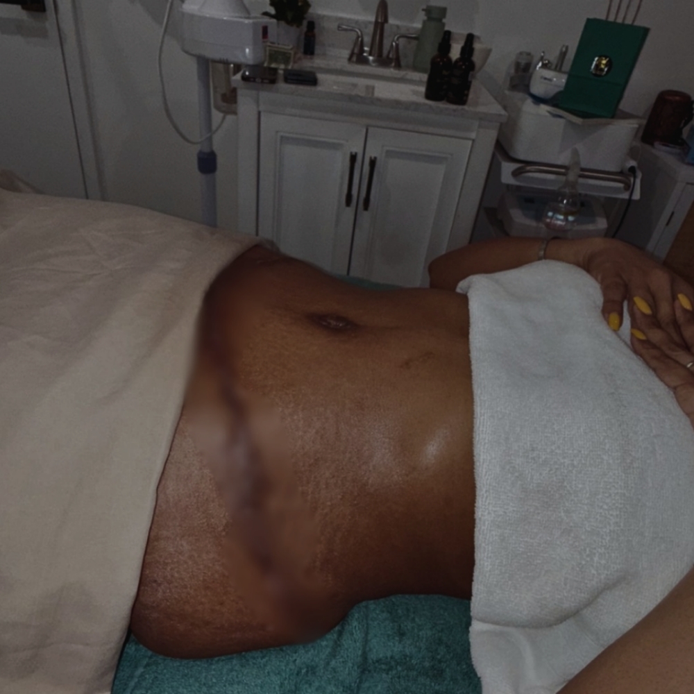 Post-Op Recovery Lymphatic Drainage at Akimat Wellness in Bayonne, NJ