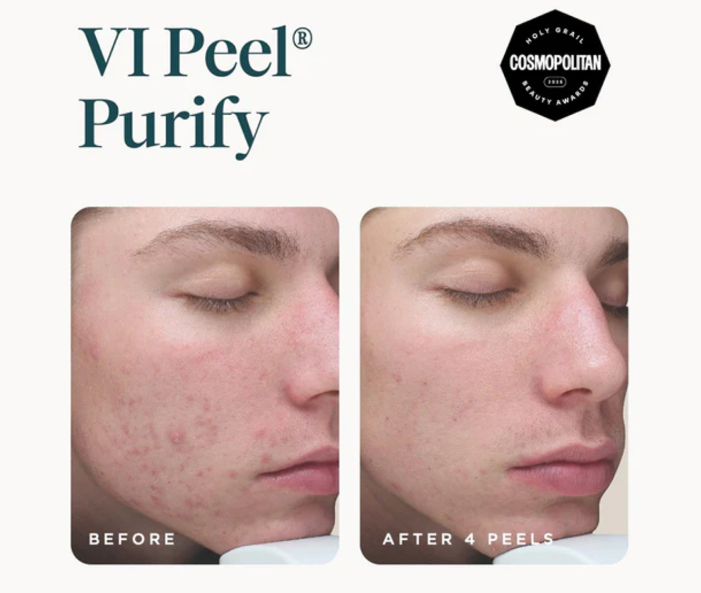 VI peel Purify