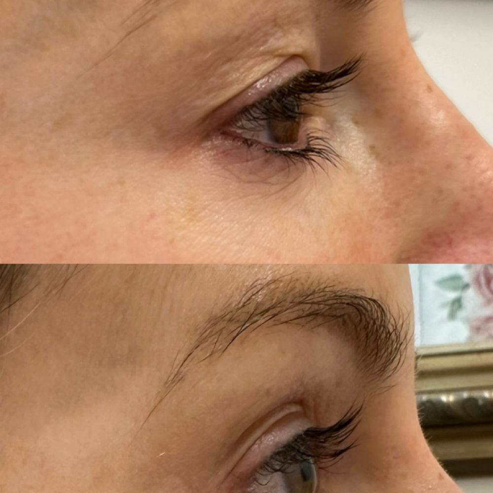 Upper Eye Lift at Magnolia Plasma Fibroblasting By Mitra in Frisco, TX