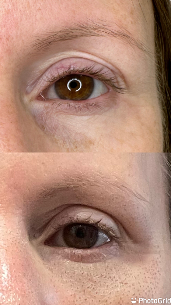 Upper Eye Lift