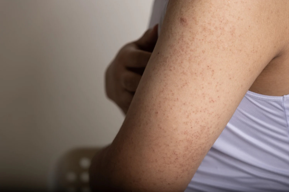 ADD-ON Keratosis Pilaris Arm Tx