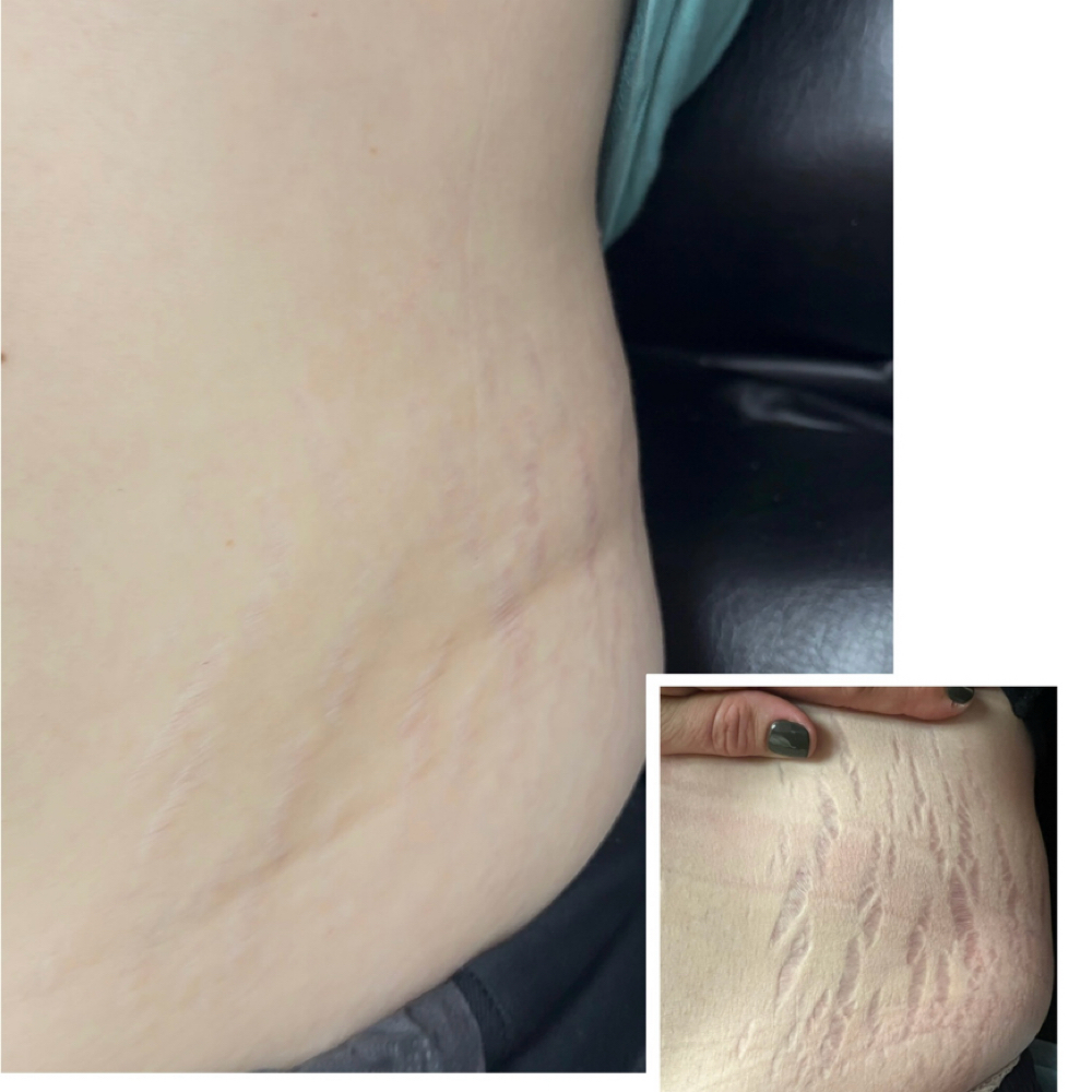 Inkless Treatment For Stretch Marks at Flawless Skin By Sarah in Roseville, CA