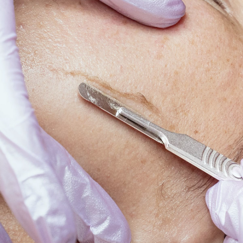 Dermaplane at RSB Med Spa in Kansas City, MO