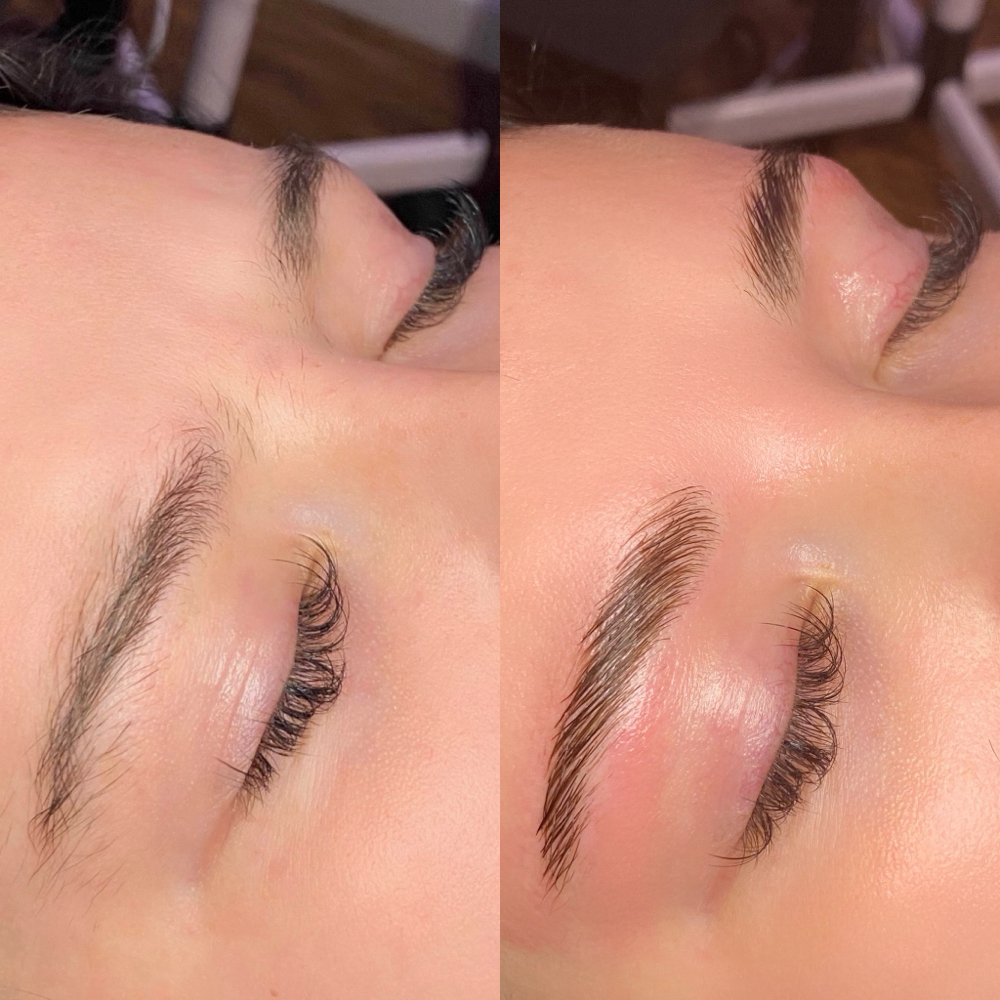 Brow Lift