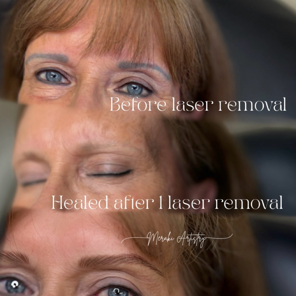 Laser PMU Removal- Brows at Meraki Artistry in Greenwood, IN