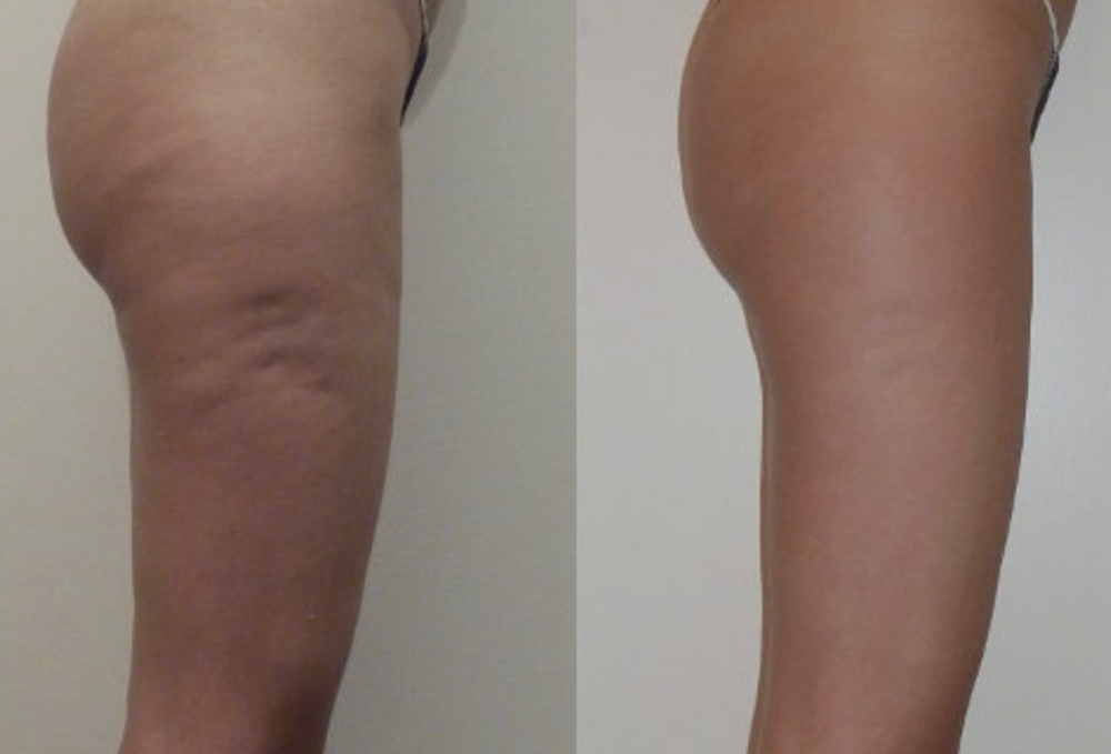 cellulite Treatment
