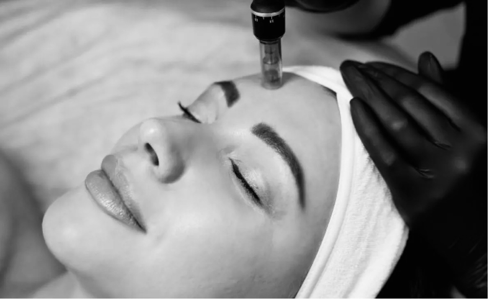 Microneedling Treatment