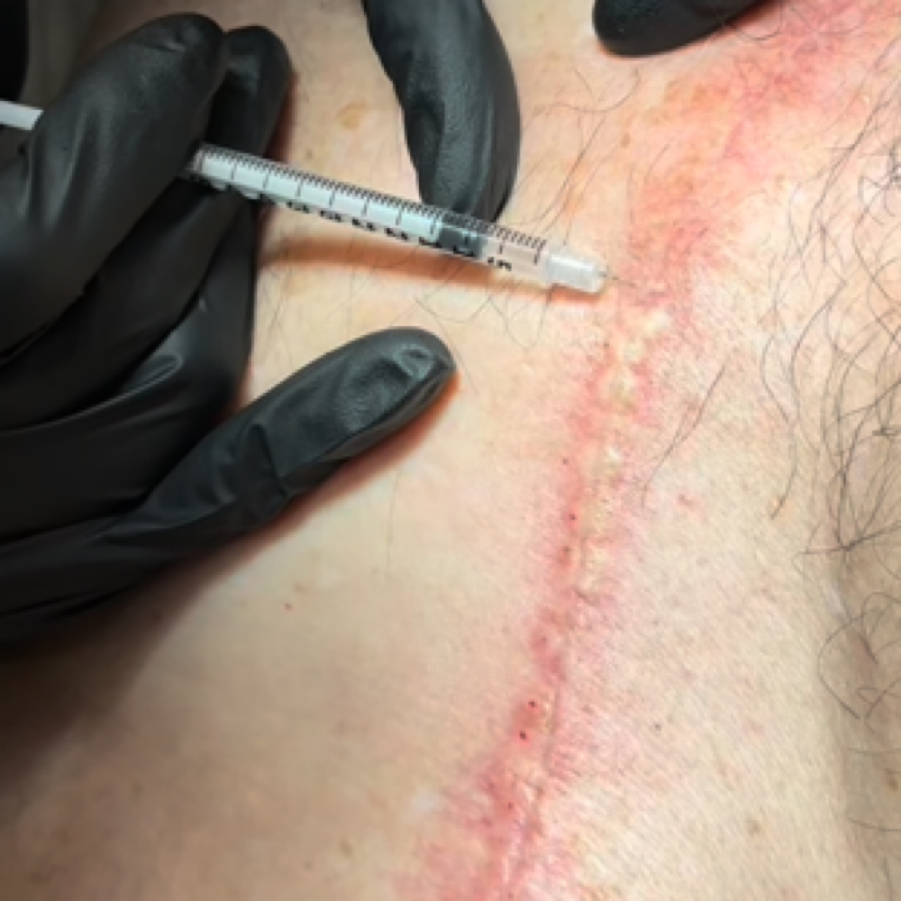 Botox For Scars at Aesthetic NP Marie in Portland, OR