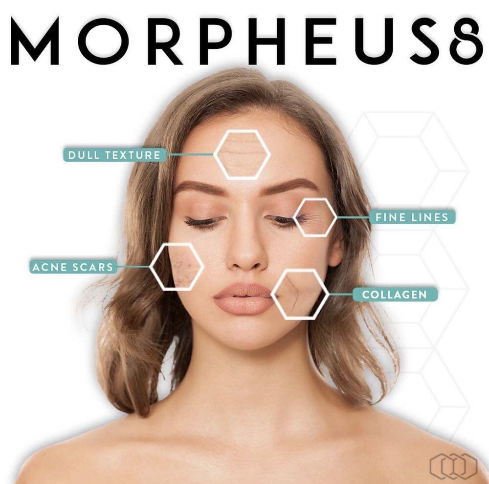 Morpheus8 Face