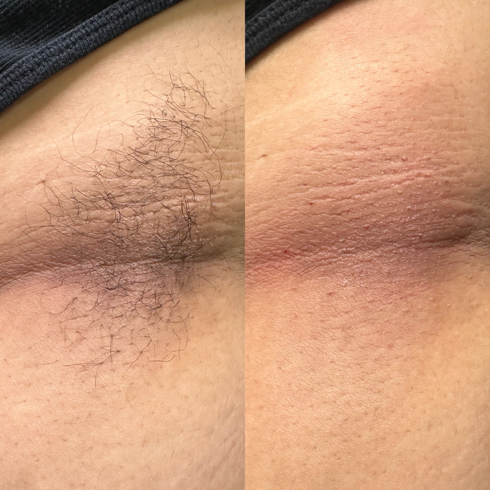 WAX - Underarms