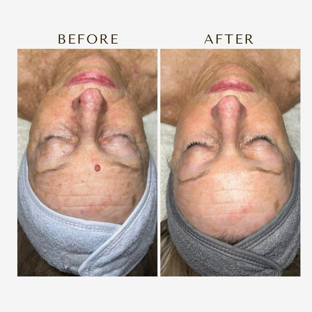 Inter. SWICH Dermal Revitalization at Haylee Jade Esthetics LLC in Ellijay, GA