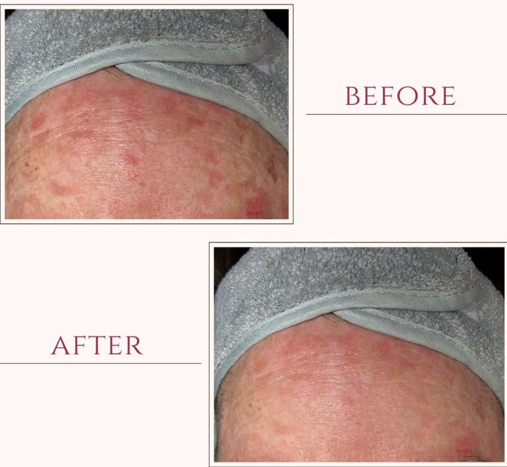 Inter. SWICH Dermal Revitalization