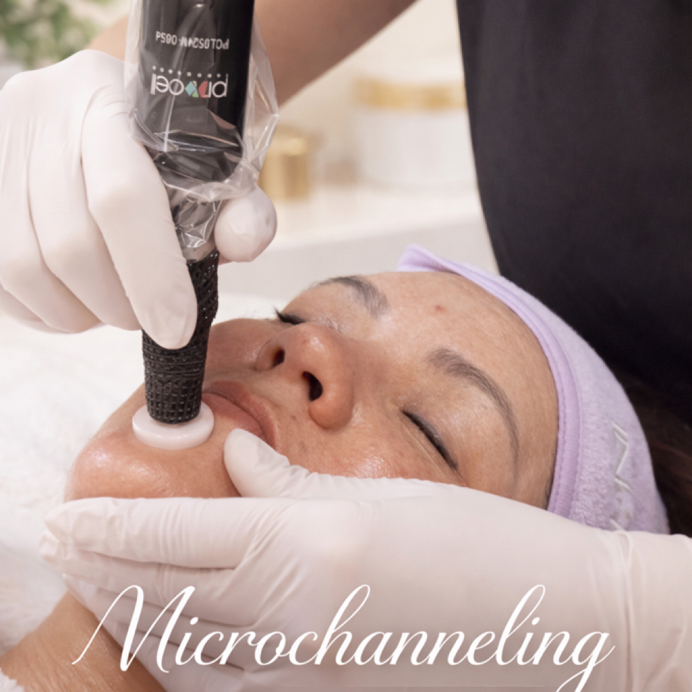 Microchanneling Series Of 3 at Aby’s Beauty Aesthetics in Fresno, CA