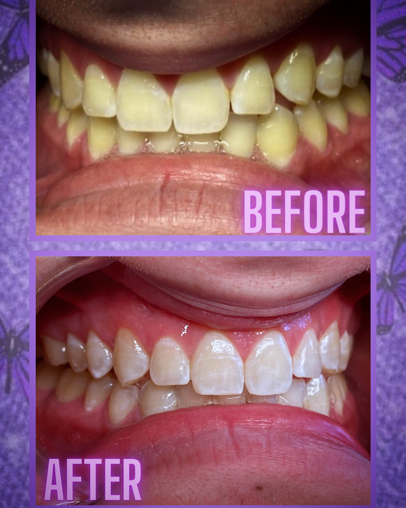 30 Min Teeth Whitening