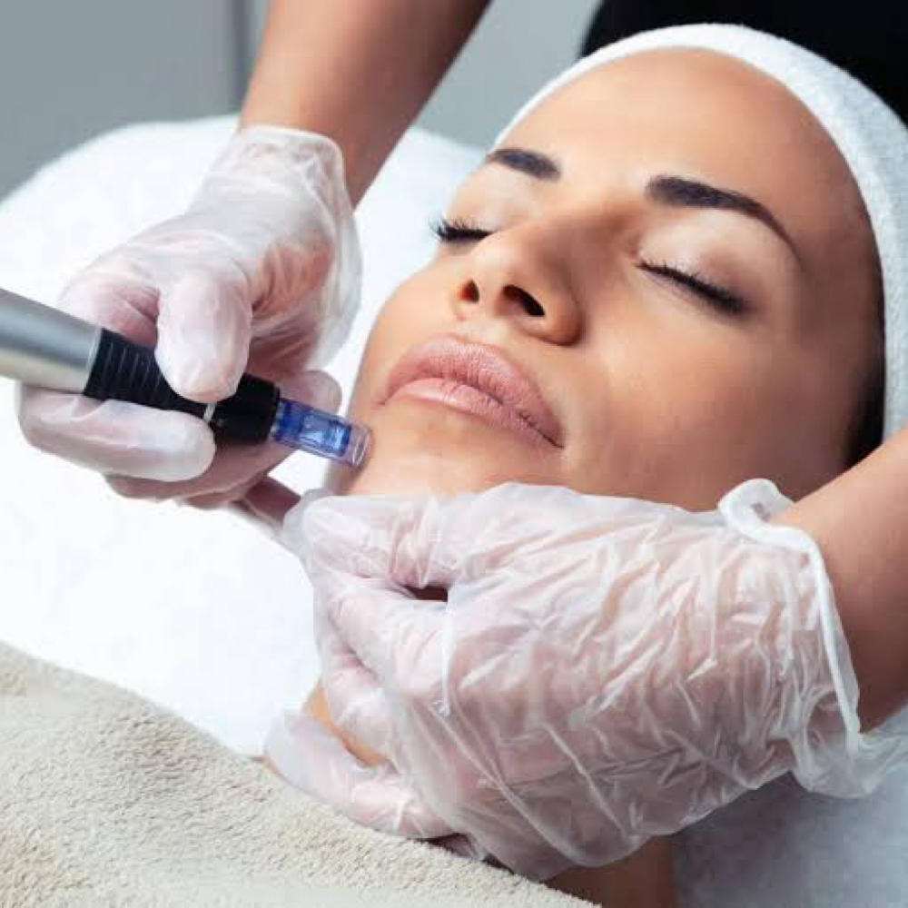 Microneedling at Glam and Glow in Huffman, TX