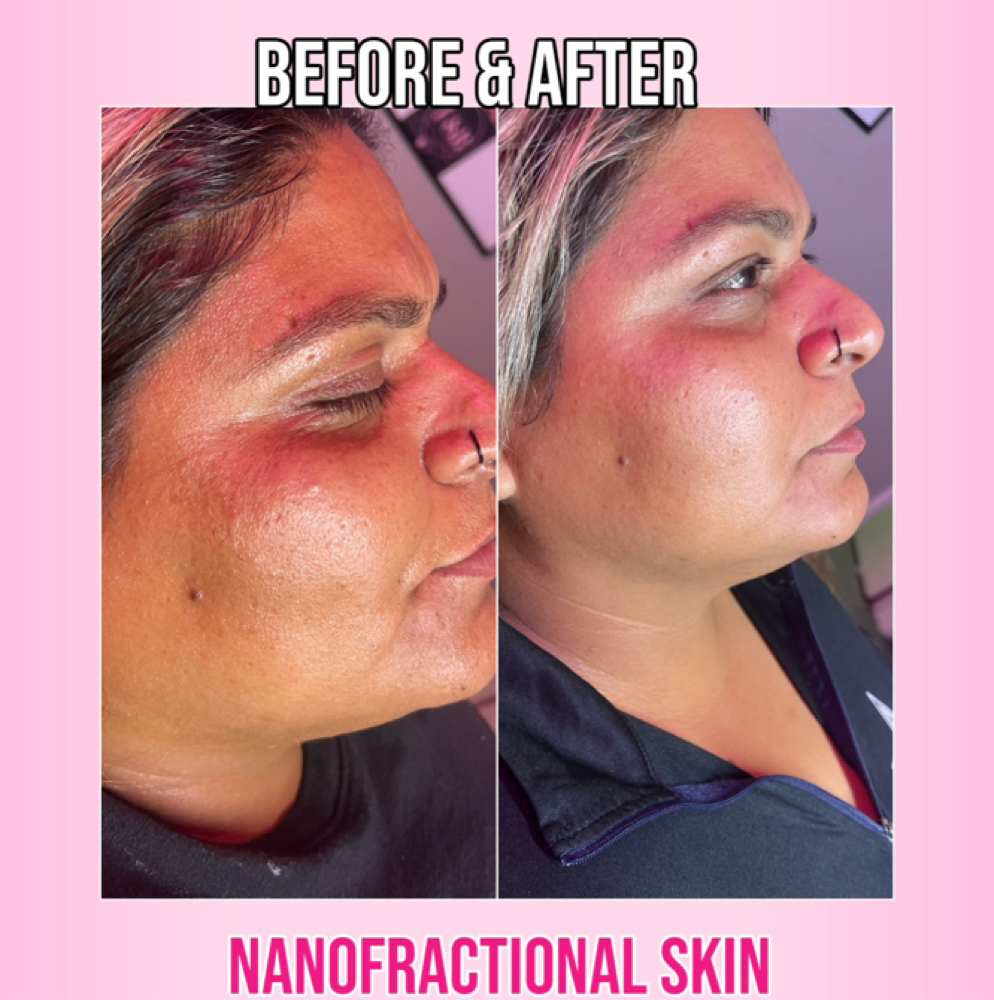 Skin Glow & Texture Package at Flawless Spa & Beauty in Fort Worth, TX