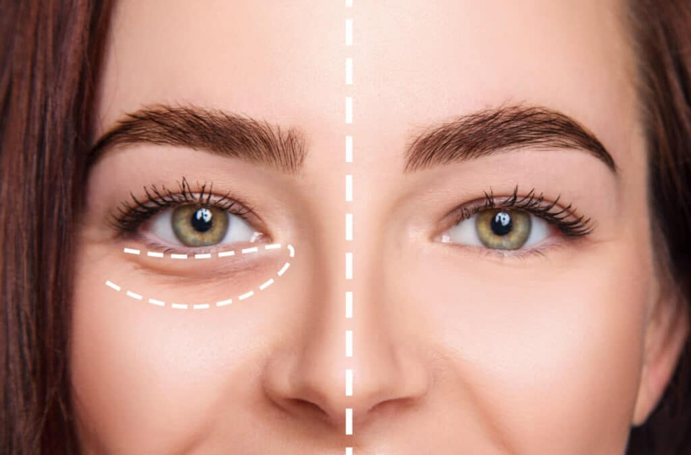 EyePro Treatment