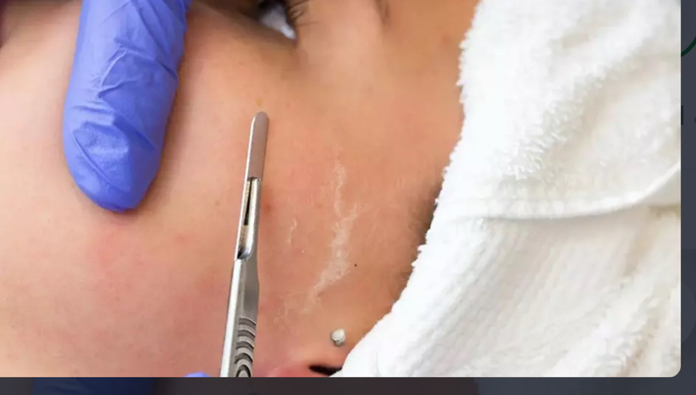Dermaplanning Facial