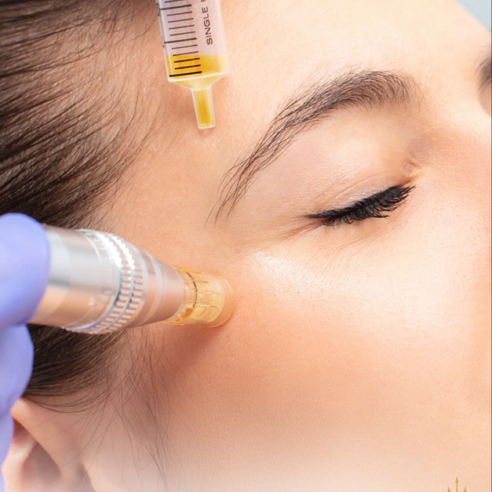 MICRONEEDLING PRP at Remake Beauty Studio San Juan in San Juan, TX