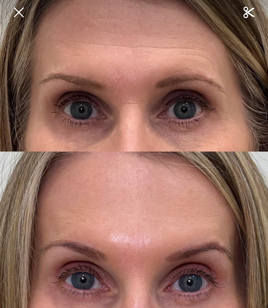 Mini Brow Lift