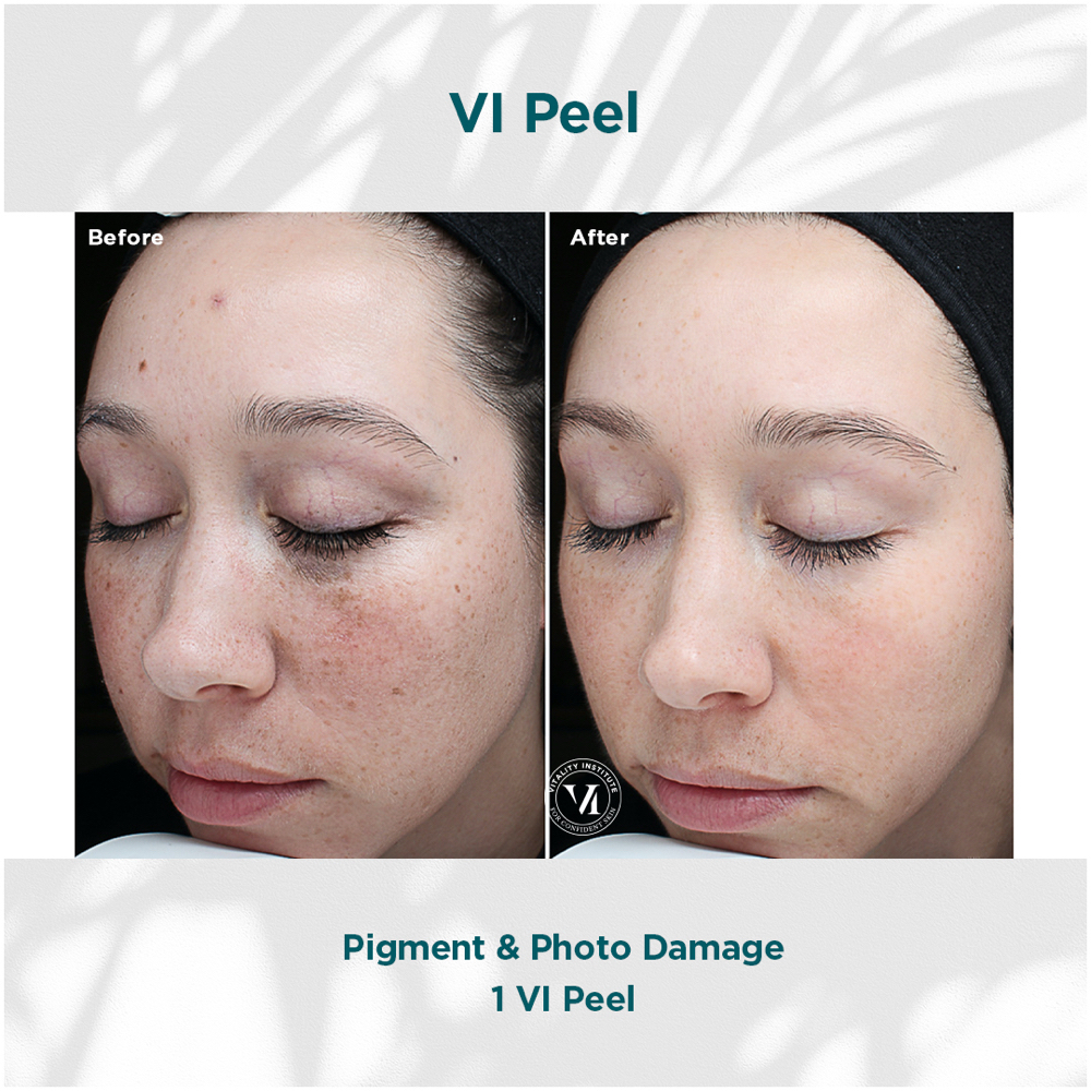 VI Peel/Original at Trilogy Aesthetics Medspa & Wellness in Atlanta, GA