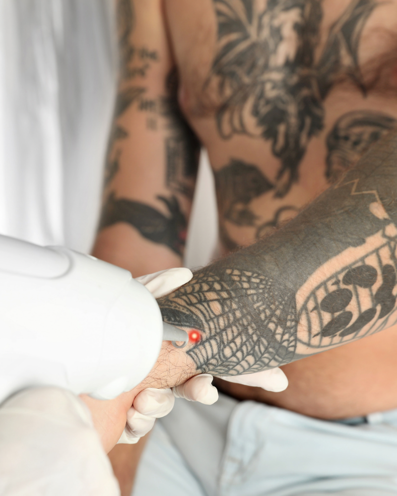 Large Area Tattoo Removal at M.A.V Aesthetics in Fort Morgan, CO