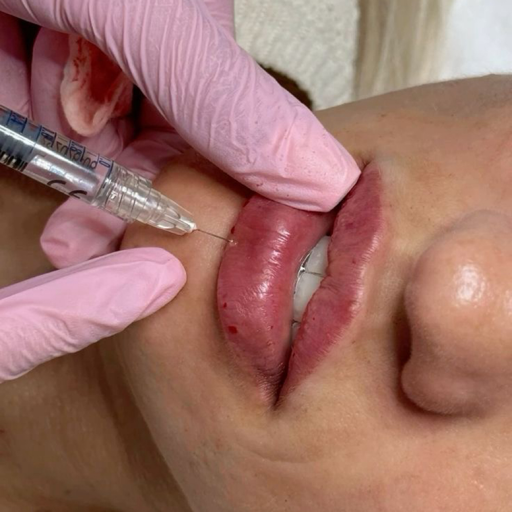 Lip Filler 1/2 Syringe at Beauty Collective Salon & Academy LLC in Friendswood, TX