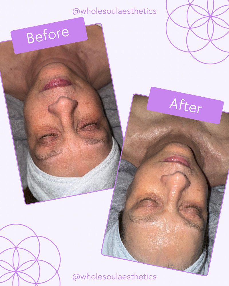 Fire + Ice Soul Facial