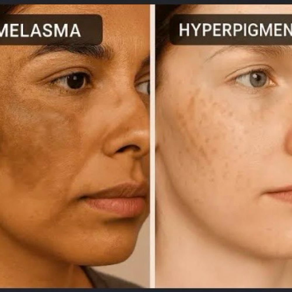 Melasma / Híperpigmentation at Merry Spa in Huntington, NY
