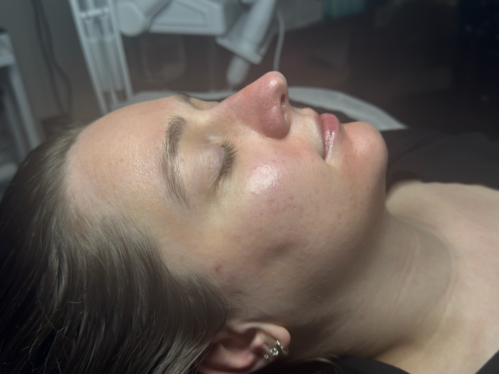 Chemical Peels